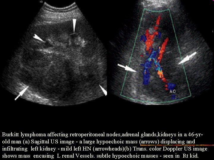 Burkitt lymphoma affecting retroperitoneal nodes, adrenal glands, kidneys in a 46 -yrold man (a)