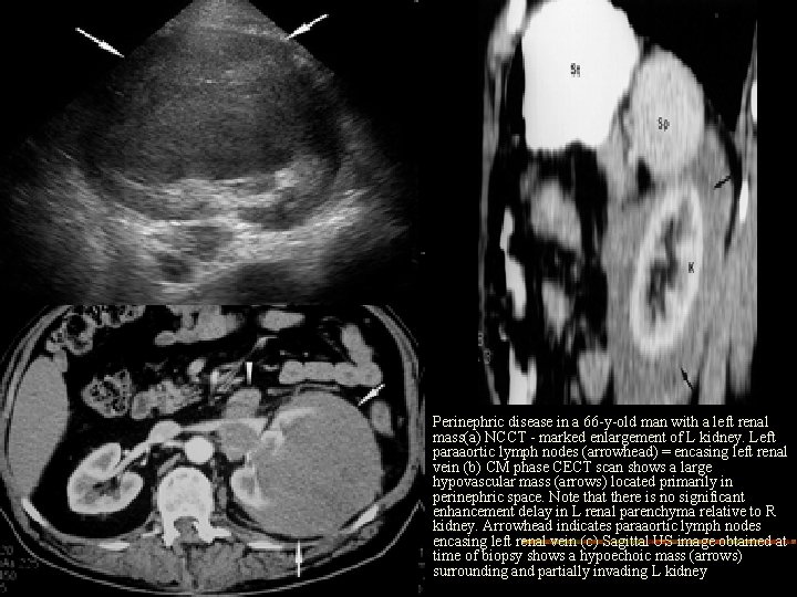 Perinephric disease in a 66 -y-old man with a left renal mass(a) NCCT -
