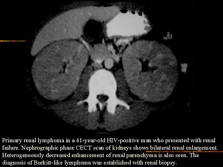 Primary renal lymphoma in a 41 -year-old HIV-positive man who presented with renal failure.