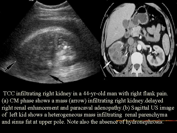 TCC infiltrating right kidney in a 44 -yr-old man with right flank pain. (a)