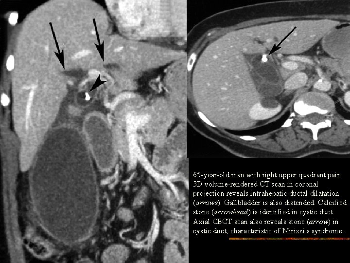 65 -year-old man with right upper quadrant pain. 3 D volume-rendered CT scan in