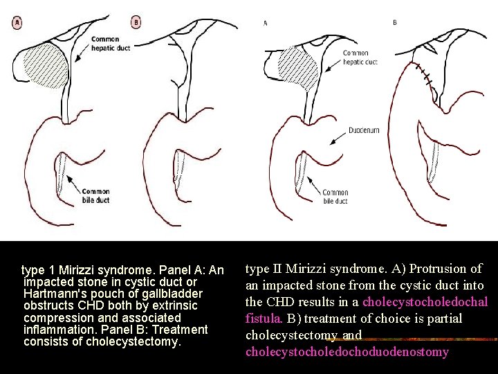 type 1 Mirizzi syndrome. Panel A: An impacted stone in cystic duct or Hartmann's