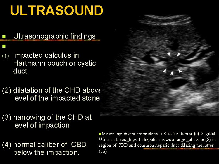 ULTRASOUND n Ultrasonographic findings n (1) impacted calculus in Hartmann pouch or cystic duct