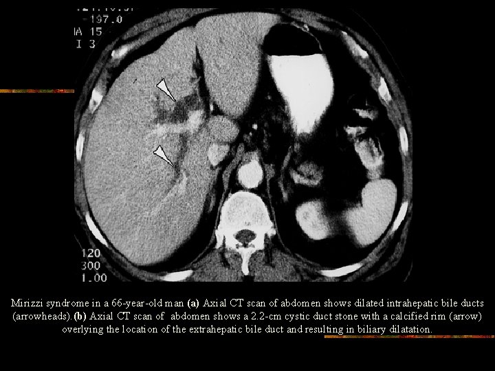 Mirizzi syndrome in a 66 -year-old man (a) Axial CT scan of abdomen shows