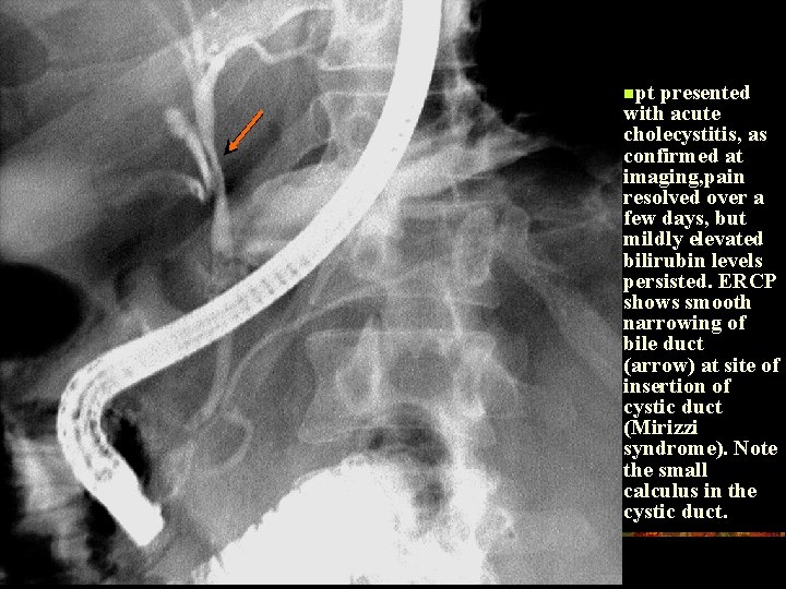 npt presented with acute cholecystitis, as confirmed at imaging, pain resolved over a few