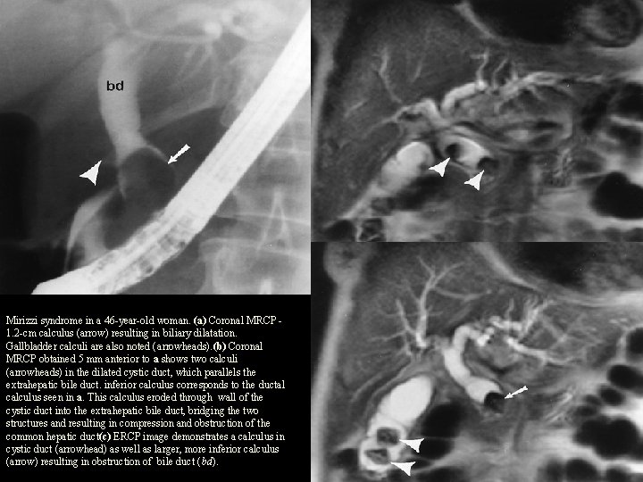 Mirizzi syndrome in a 46 -year-old woman. (a) Coronal MRCP 1. 2 -cm calculus