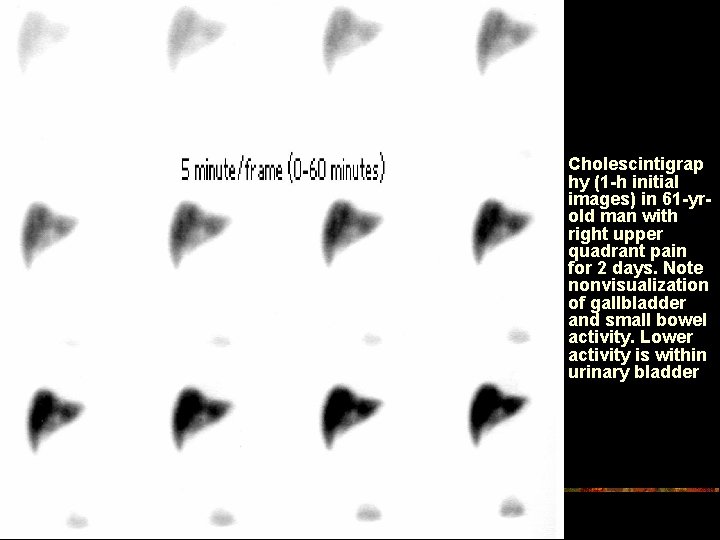 n Cholescintigrap hy (1 -h initial images) in 61 -yrold man with right upper