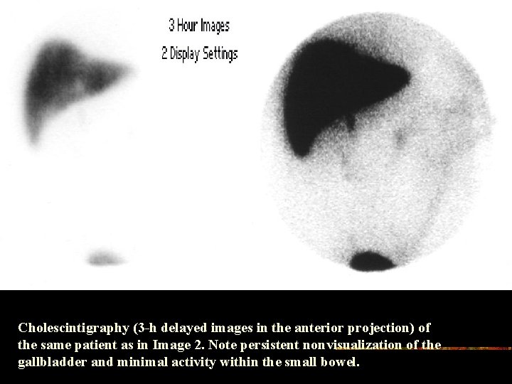 Cholescintigraphy (3 -h delayed images in the anterior projection) of the same patient as