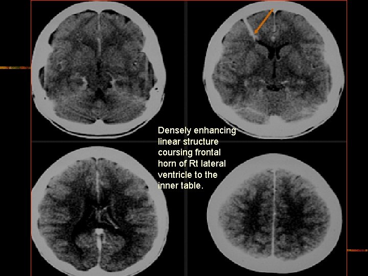 Densely enhancing linear structure coursing frontal horn of Rt lateral ventricle to the inner