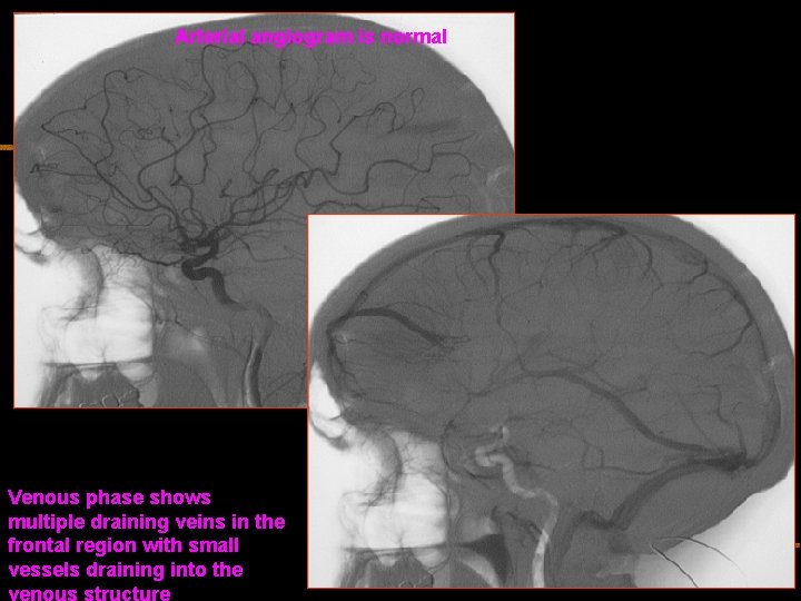 Arterial angiogram is normal Venous phase shows multiple draining veins in the frontal region