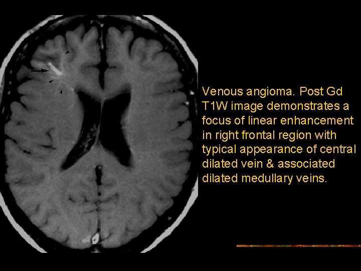 Venous angioma. Post Gd T 1 W image demonstrates a focus of linear enhancement