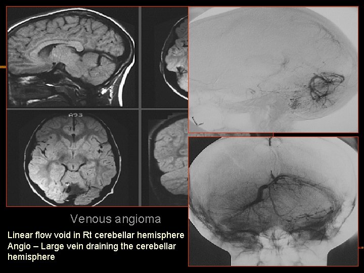 Venous angioma Linear flow void in Rt cerebellar hemisphere Angio – Large vein draining