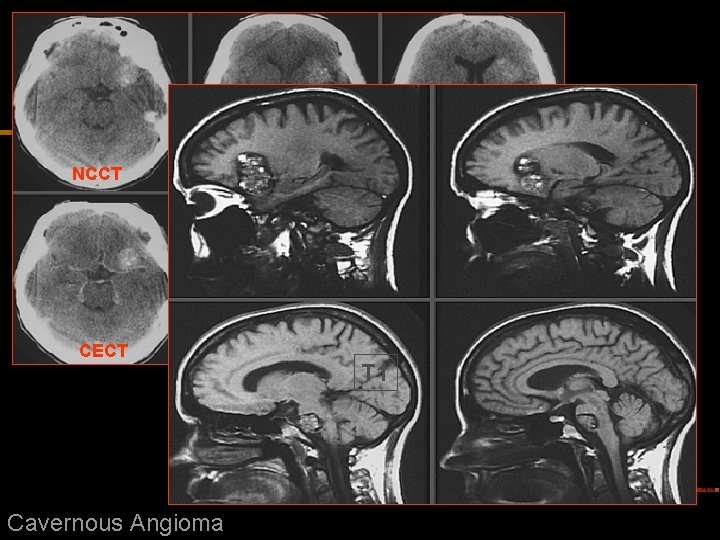 NCCT CECT Cavernous Angioma T 1 