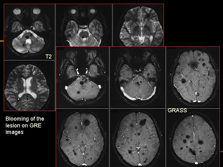 T 2 GRASS Blooming of the lesion on GRE images 