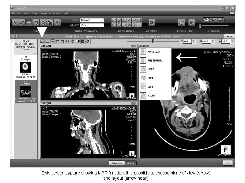 Onis screen capture showing MPR function. It is possible to choose plane of view