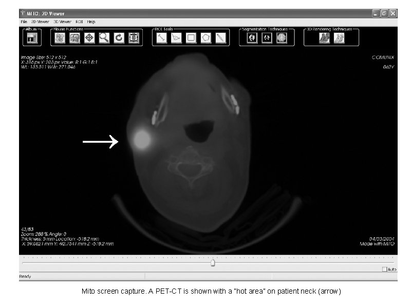 Mito screen capture. A PET-CT is shown with a “hot area” on patient neck