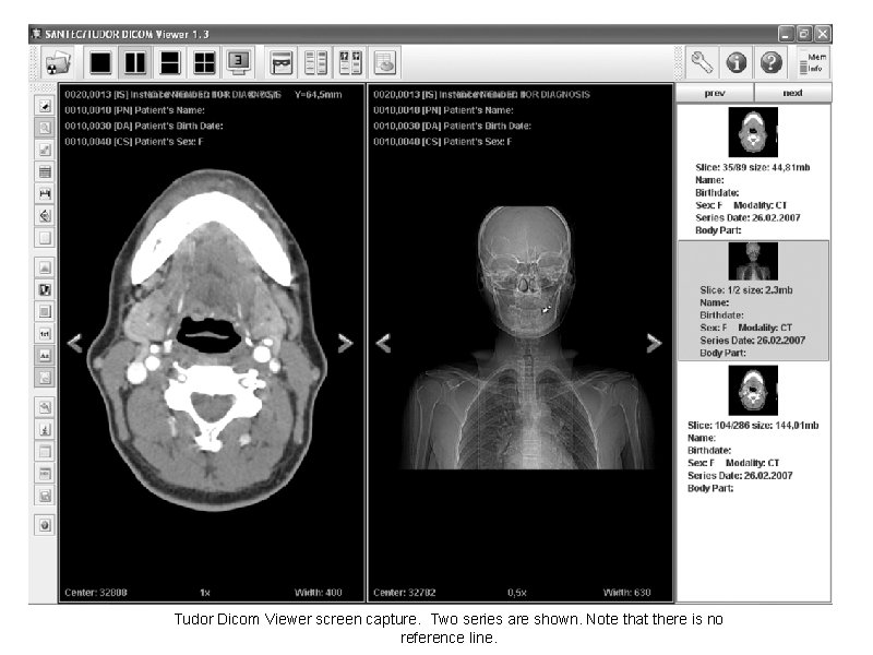 Tudor Dicom Viewer screen capture. Two series are shown. Note that there is no