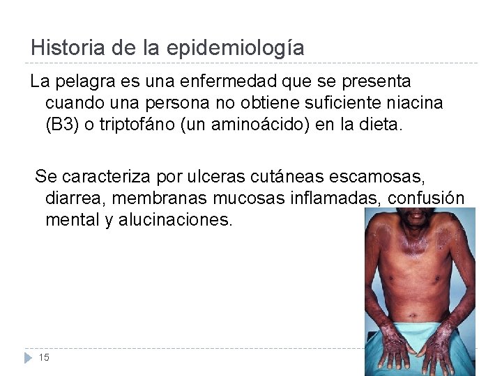 Historia de la epidemiología La pelagra es una enfermedad que se presenta cuando una