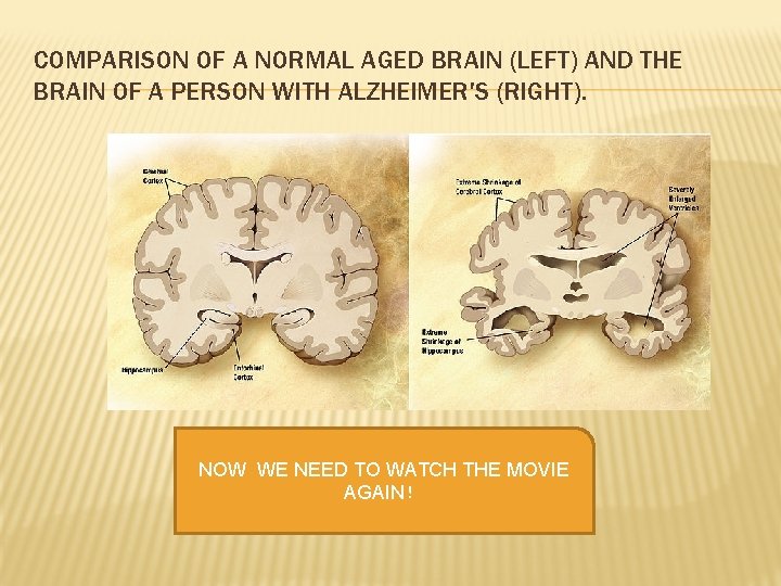 COMPARISON OF A NORMAL AGED BRAIN (LEFT) AND THE BRAIN OF A PERSON WITH