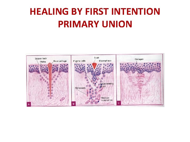 HEALING BY FIRST INTENTION PRIMARY UNION 