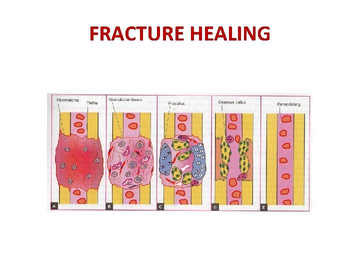 FRACTURE HEALING 