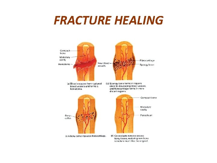 FRACTURE HEALING 