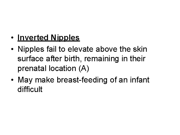  • Inverted Nipples • Nipples fail to elevate above the skin surface after