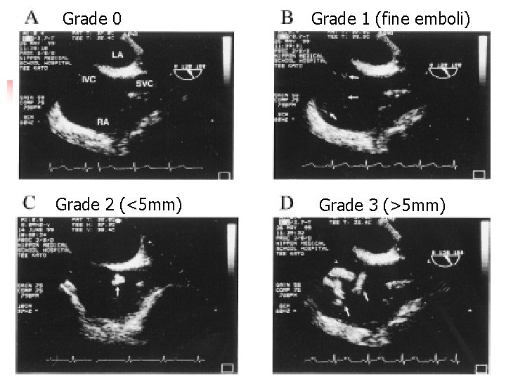 Grade 0 Grade 2 (<5 mm) Grade 1 (fine emboli) Grade 3 (>5 mm)