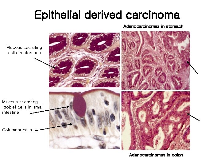 Epithelial derived carcinoma Adenocarcinomas in stomach Mucous secreting cells in stomach Mucous secreting goblet