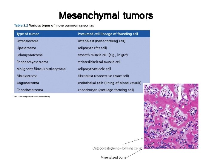 Mesenchymal tumors 