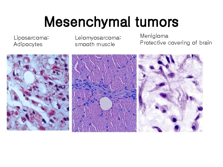 Mesenchymal tumors Liposarcoma: Adipocytes Leiomyosarcoma: smooth muscle Menigioma Protective covering of brain 