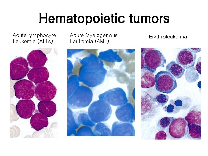 Hematopoietic tumors Acute lymphocyte Leukemia (ALLs) Acute Myelogenous Leukemia (AML) Erythroleukemia 