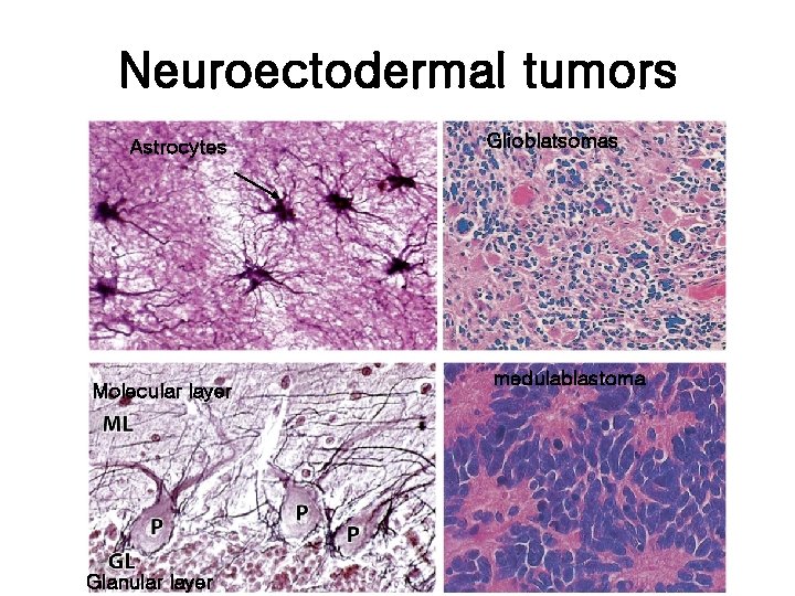 Neuroectodermal tumors Astrocytes Molecular layer Glanular layer Glioblatsomas medulablastoma 