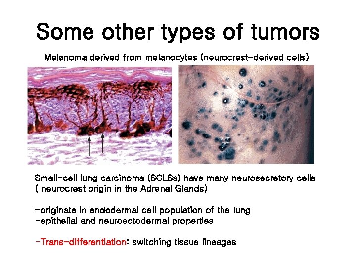 Some other types of tumors Melanoma derived from melanocytes (neurocrest-derived cells) Small-cell lung carcinoma