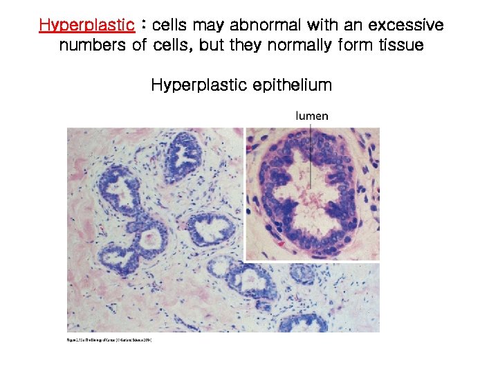 Hyperplastic : cells may abnormal with an excessive numbers of cells, but they normally