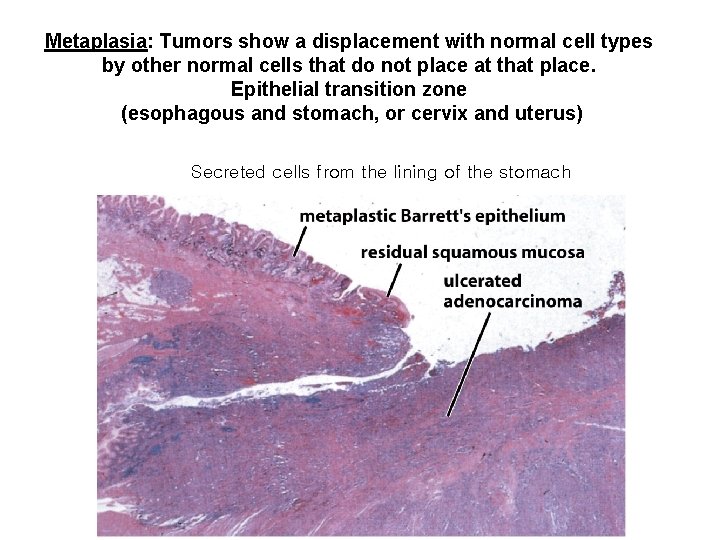 Metaplasia: Tumors show a displacement with normal cell types by other normal cells that