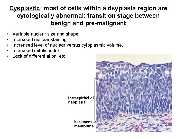 Dysplastic: most of cells within a dsyplasia region are cytologically abnormal: transition stage between