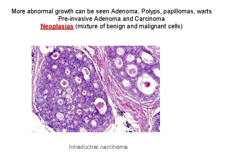 More abnormal growth can be seen Adenoma, Polyps, papillomas, warts Pre-invasive Adenoma and Carcinoma