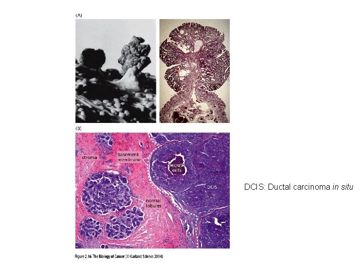 DCIS: Ductal carcinoma in situ 