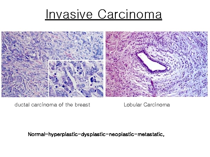 Invasive Carcinoma ductal carcinoma of the breast Lobular Carcinoma Normal-hyperplastic-dysplastic-neoplastic-metastatic, 