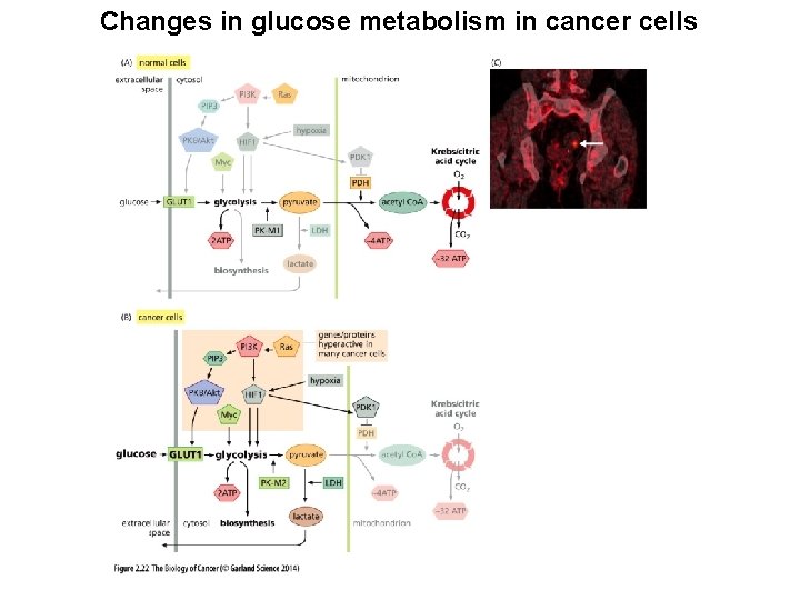 Changes in glucose metabolism in cancer cells 