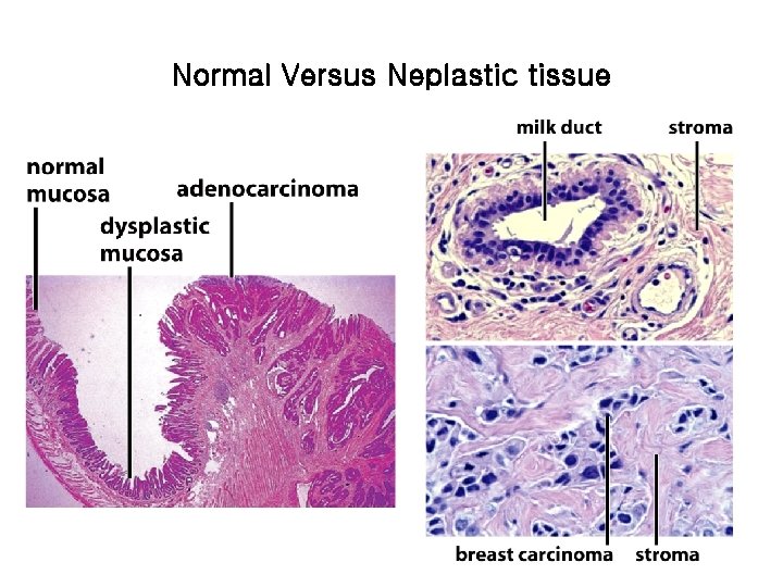 Normal Versus Neplastic tissue 