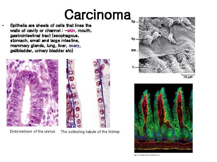 Carcinoma • Epithelia are sheets of cells that lines the walls of cavity or