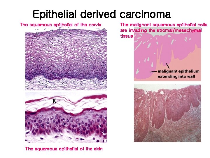 Epithelial derived carcinoma The squamous epithelial of the cervix The squamous epithelial of the
