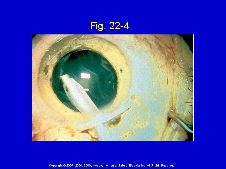 Fig. 22 -4 Copyright © 2007, 2004, 2000, Mosby, Inc. , an affiliate of