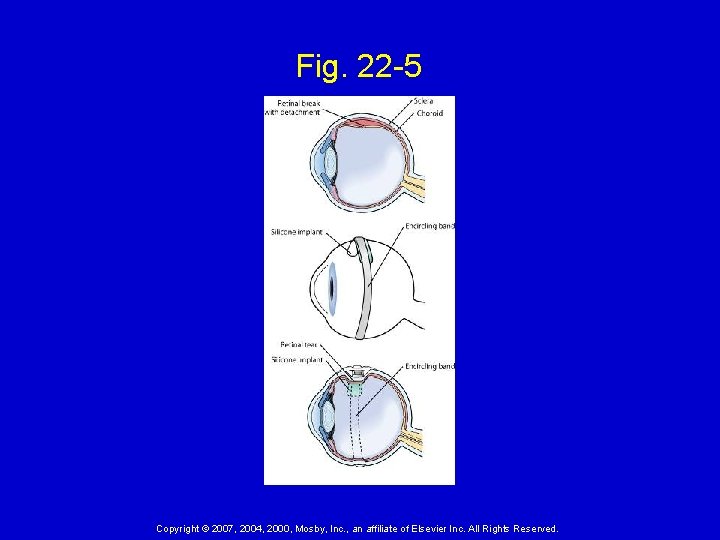 Fig. 22 -5 Copyright © 2007, 2004, 2000, Mosby, Inc. , an affiliate of