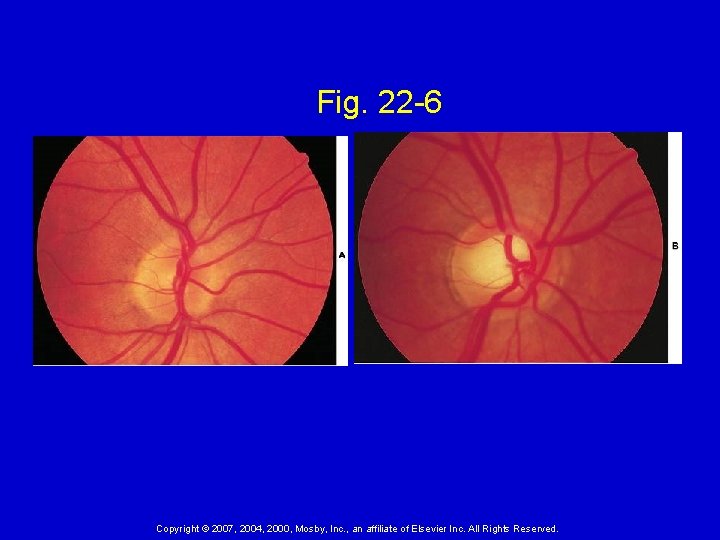 Fig. 22 -6 Copyright © 2007, 2004, 2000, Mosby, Inc. , an affiliate of