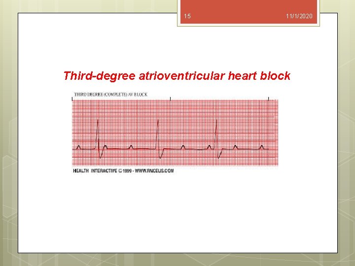 15 11/1/2020 Third-degree atrioventricular heart block 
