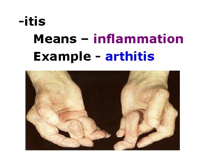 -itis Means – inflammation Example - arthitis 