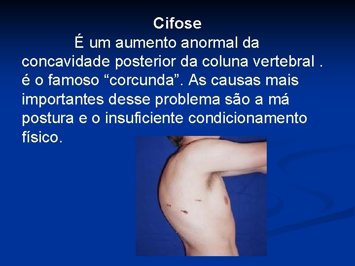 Cifose É um aumento anormal da concavidade posterior da coluna vertebral. é o famoso